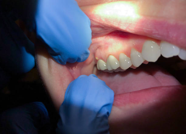 Best Emergency Tooth Extraction in Newark, TX