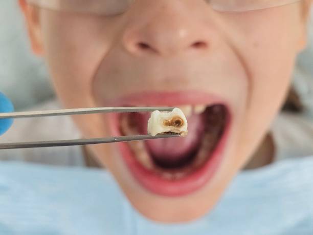 Best Emergency Tooth Extraction in Newark, TX